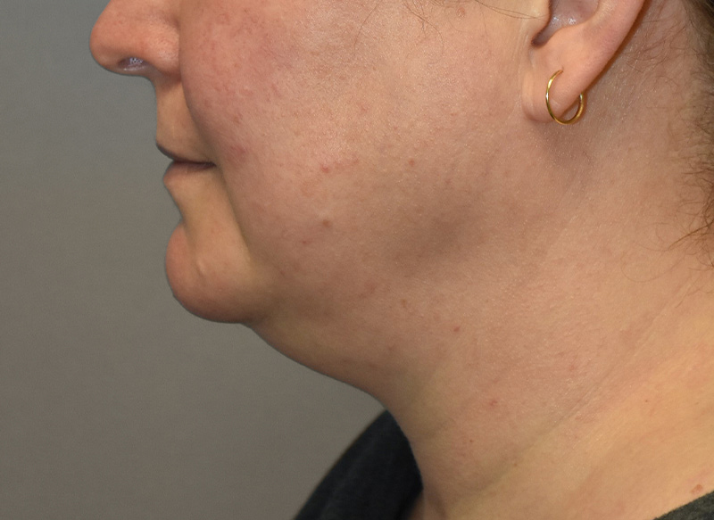 SUBMENTAL LIPOSUCTION Before & After Gallery - Patient 292350 - Image 1