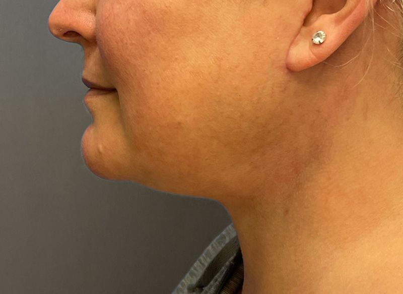 SUBMENTAL LIPOSUCTION Before & After Gallery - Patient 292350 - Image 2