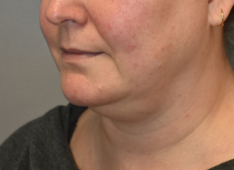 SUBMENTAL LIPOSUCTION Before & After Gallery - Patient 292350 - Image 3