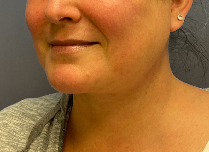 SUBMENTAL LIPOSUCTION Before & After Gallery - Patient 292350 - Image 4