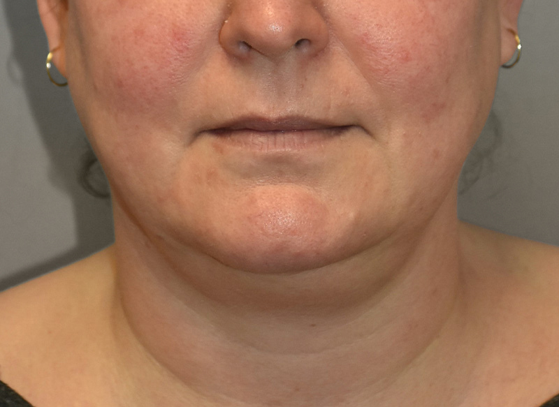 SUBMENTAL LIPOSUCTION Before & After Gallery - Patient 292350 - Image 5