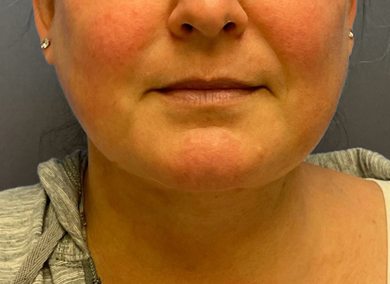 SUBMENTAL LIPOSUCTION Before & After Gallery - Patient 292350 - Image 6