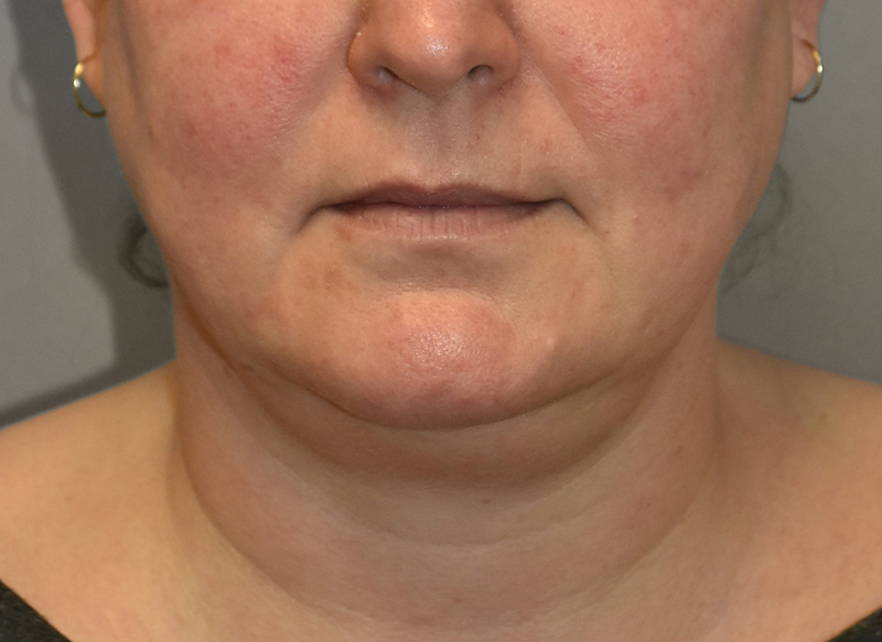 SUBMENTAL LIPOSUCTION Before & After Gallery - Patient 292350 - Image 7