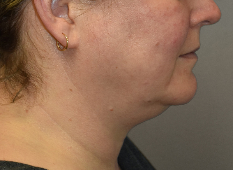SUBMENTAL LIPOSUCTION Before & After Gallery - Patient 292350 - Image 11