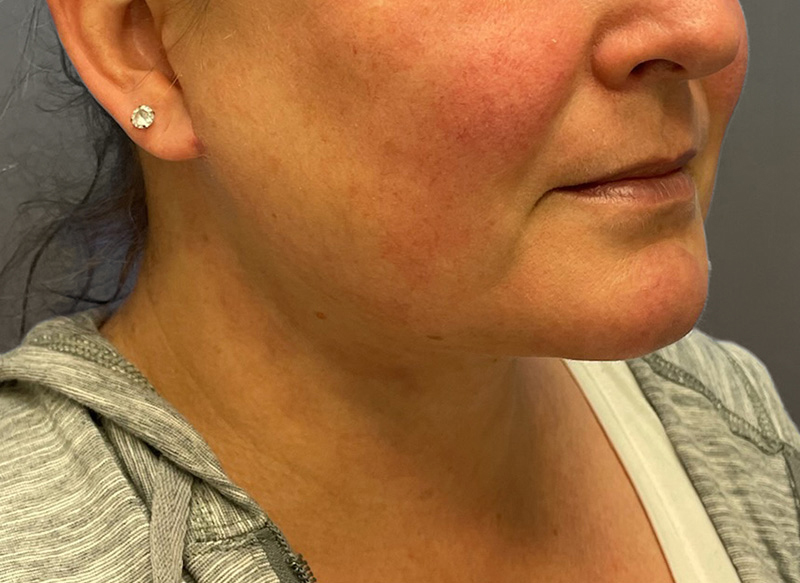 SUBMENTAL LIPOSUCTION Before & After Gallery - Patient 292350 - Image 10