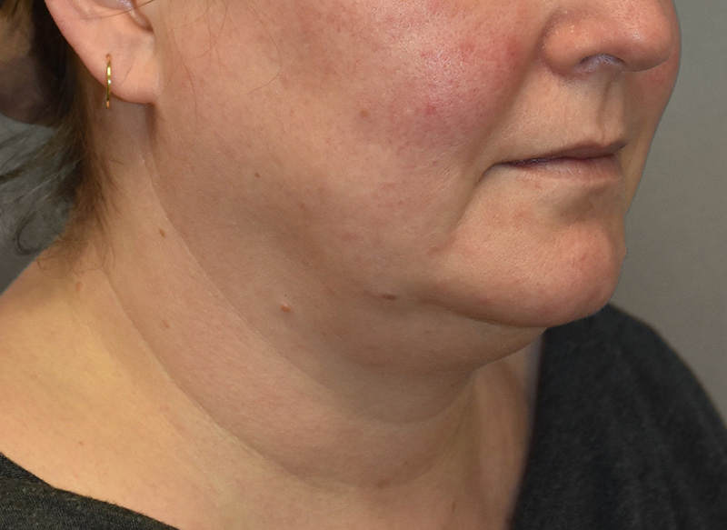 SUBMENTAL LIPOSUCTION Before & After Gallery - Patient 292350 - Image 9