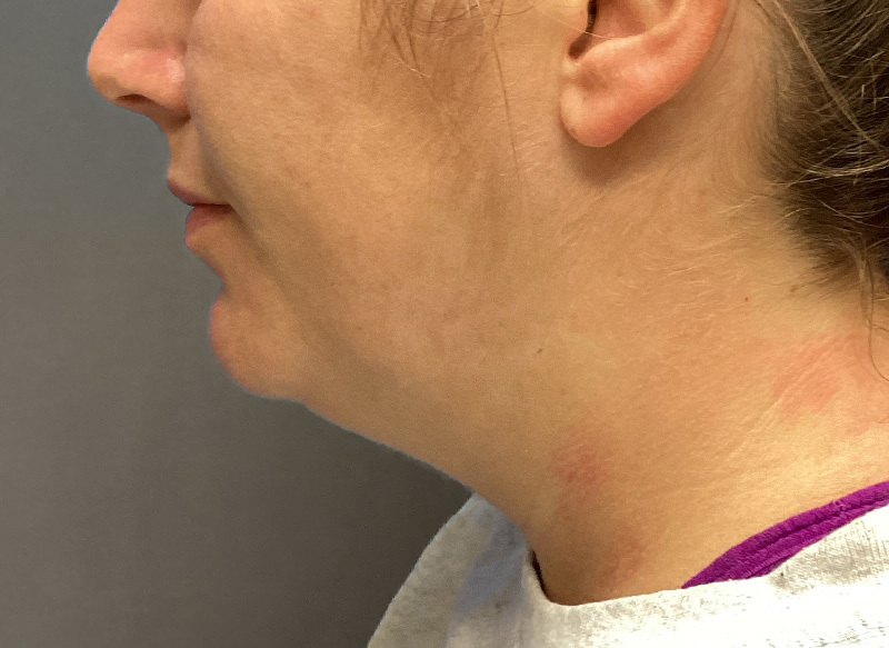 SUBMENTAL LIPOSUCTION Before & After Gallery - Patient 384657 - Image 1