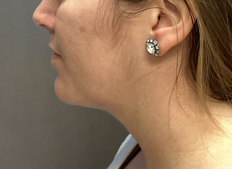 SUBMENTAL LIPOSUCTION Before & After Gallery - Patient 384657 - Image 2