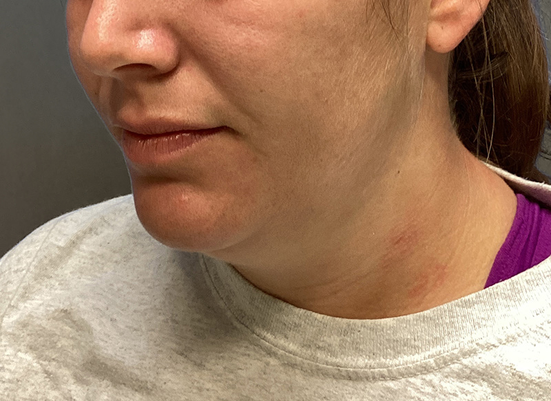 SUBMENTAL LIPOSUCTION Before & After Gallery - Patient 384657 - Image 3