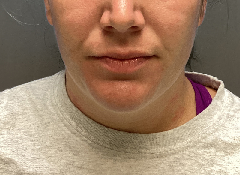 SUBMENTAL LIPOSUCTION Before & After Gallery - Patient 384657 - Image 5