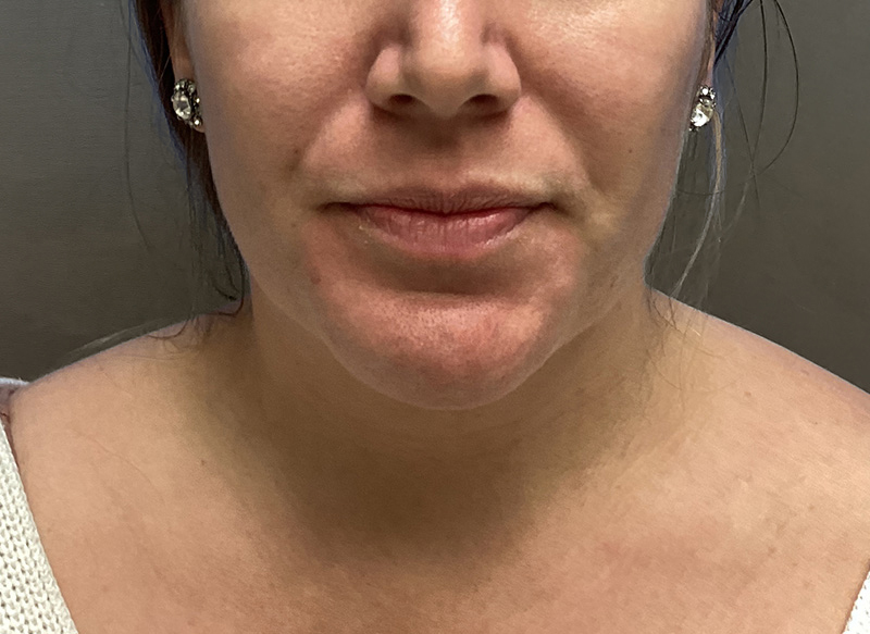 SUBMENTAL LIPOSUCTION Before & After Gallery - Patient 384657 - Image 6