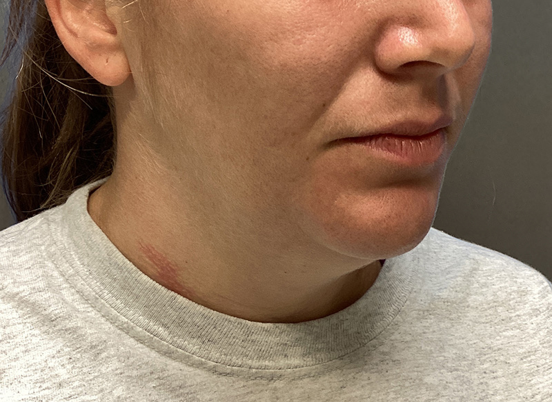 SUBMENTAL LIPOSUCTION Before & After Gallery - Patient 384657 - Image 7