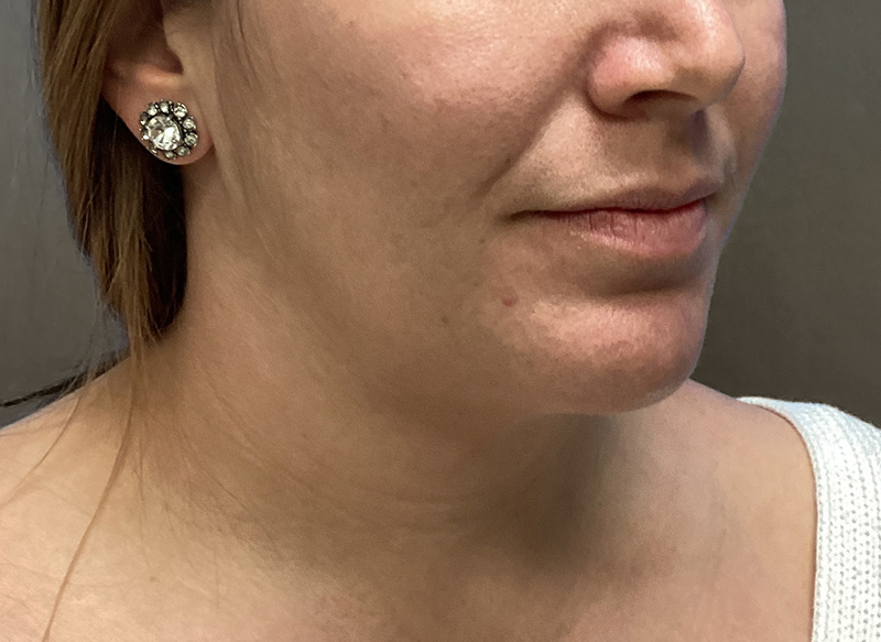 SUBMENTAL LIPOSUCTION Before & After Gallery - Patient 384657 - Image 8