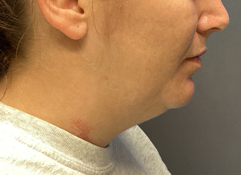 SUBMENTAL LIPOSUCTION Before & After Gallery - Patient 384657 - Image 9