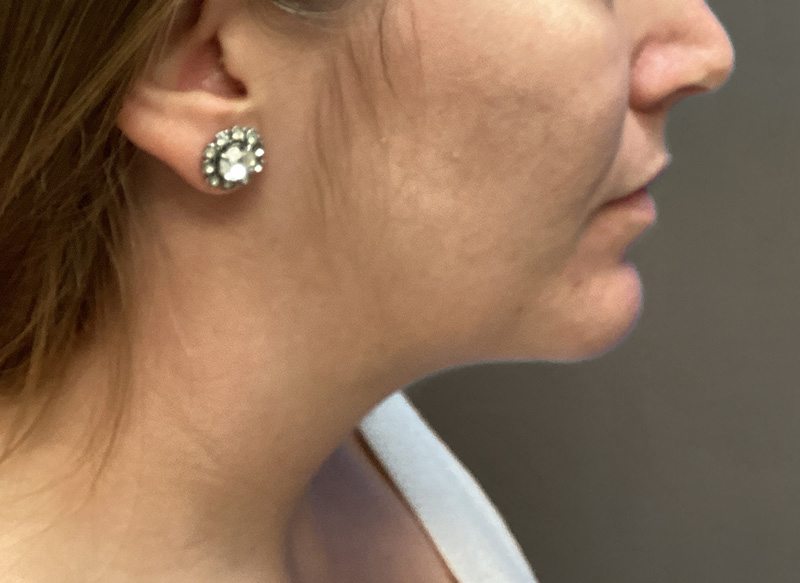 SUBMENTAL LIPOSUCTION Before & After Gallery - Patient 384657 - Image 10