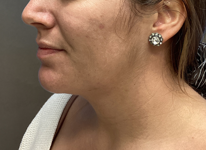 SUBMENTAL LIPOSUCTION Before & After Gallery - Patient 384657 - Image 4