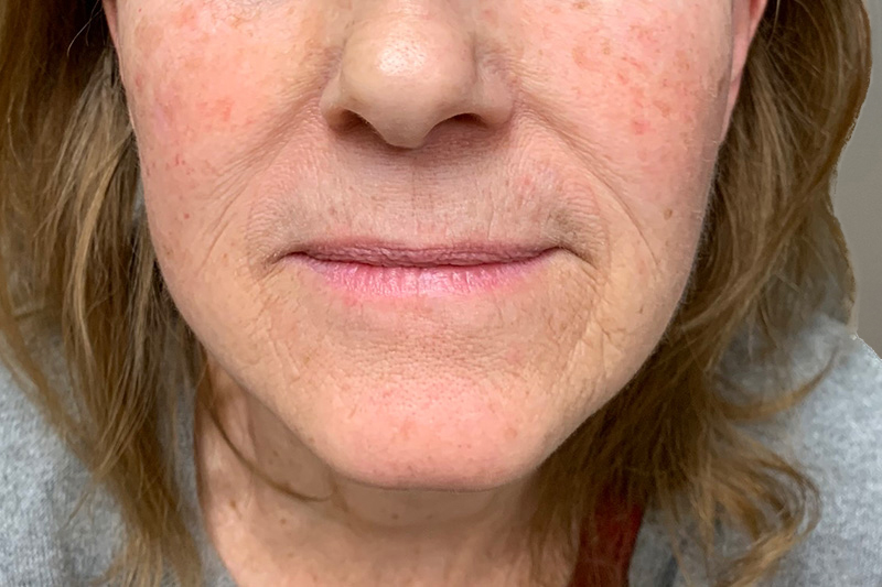 SUBMENTAL LIPOSUCTION Before & After Gallery - Patient 472570 - Image 2