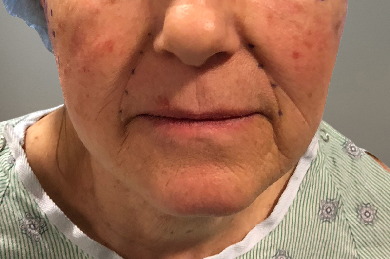 SUBMENTAL LIPOSUCTION Before & After Gallery - Patient 472570 - Image 1