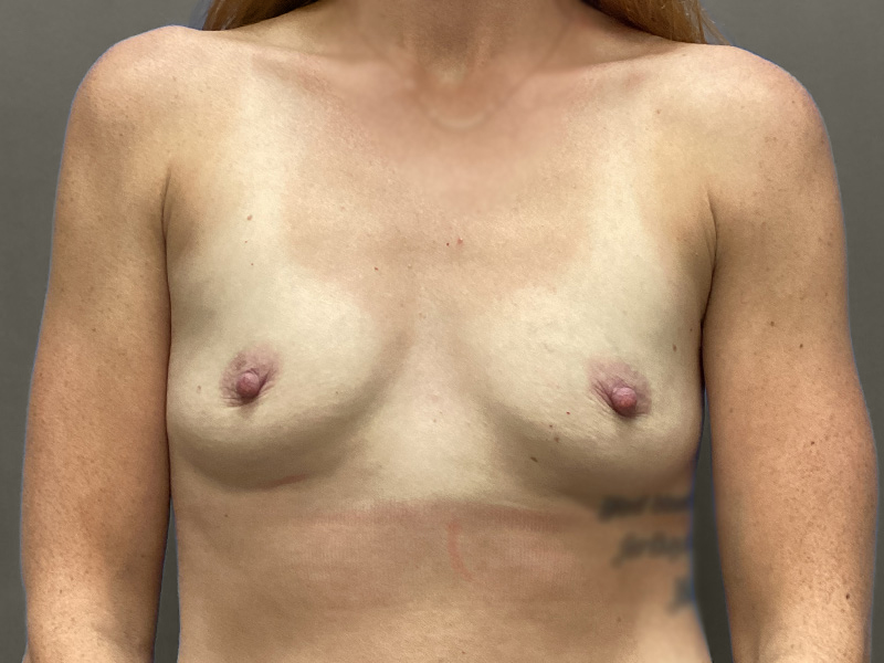 BREAST AUGMENTATION Before & After Gallery - Patient 354347 - Image 1