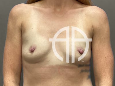 BREAST AUGMENTATION Before & After Gallery - Patient 354347 - Image 1