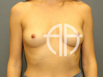 BREAST AUGMENTATION Before & After Gallery - Patient 374825 - Image 1