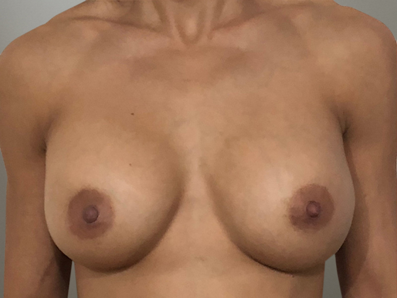 BREAST AUGMENTATION Before & After Gallery - Patient 396412 - Image 2