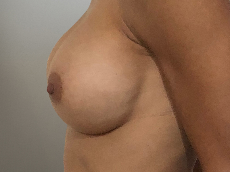 BREAST AUGMENTATION Before & After Gallery - Patient 396412 - Image 8