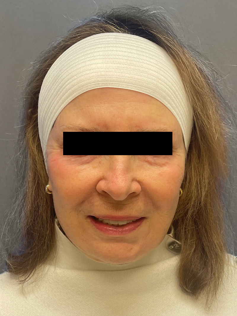 FAT GRAFTING Before & After Gallery - Patient 202145 - Image 2