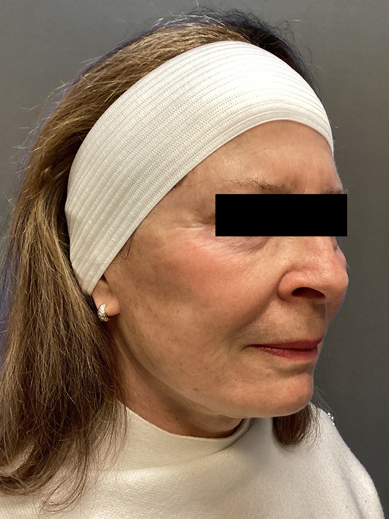 FAT GRAFTING Before & After Gallery - Patient 202145 - Image 4