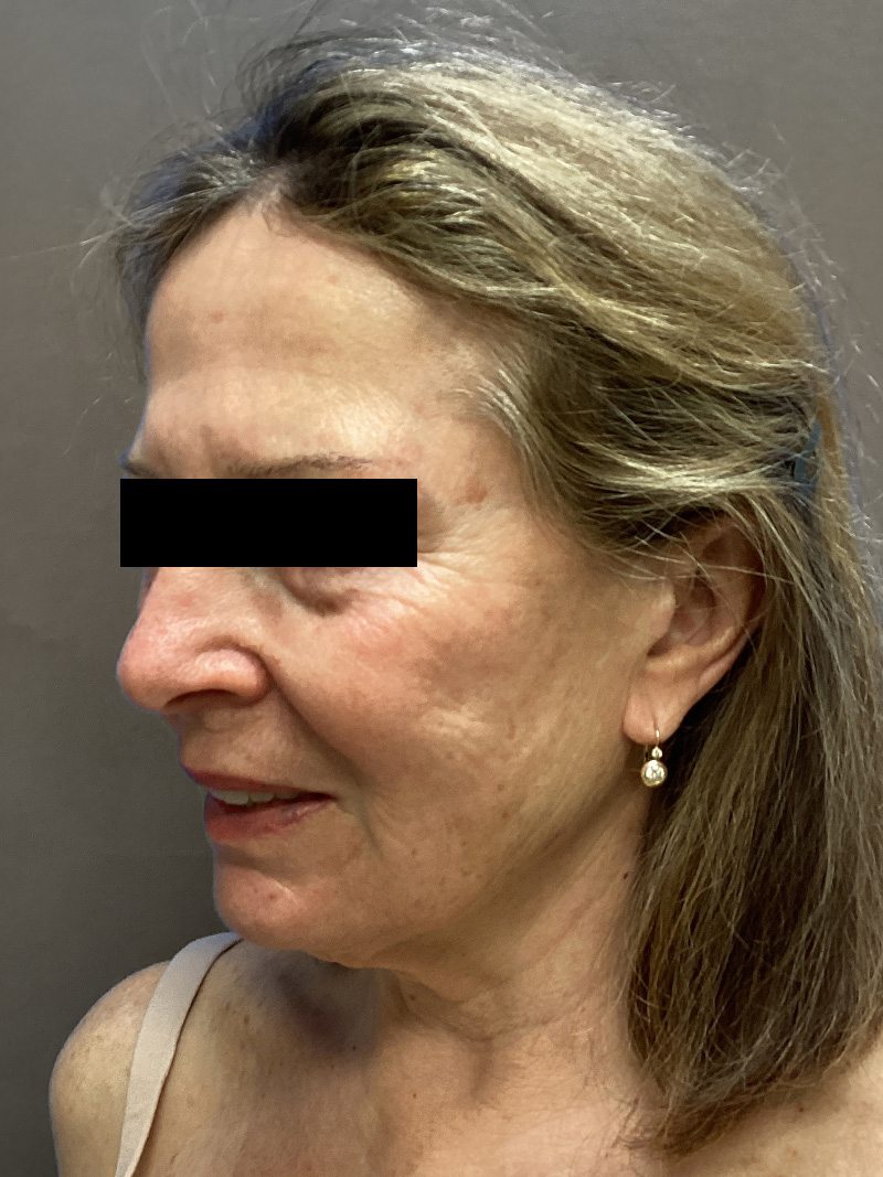 FAT GRAFTING Before & After Gallery - Patient 202145 - Image 5