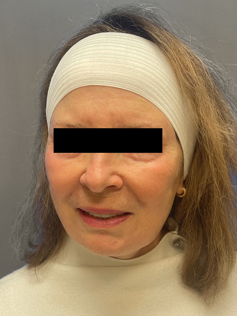 FAT GRAFTING Before & After Gallery - Patient 202145 - Image 6