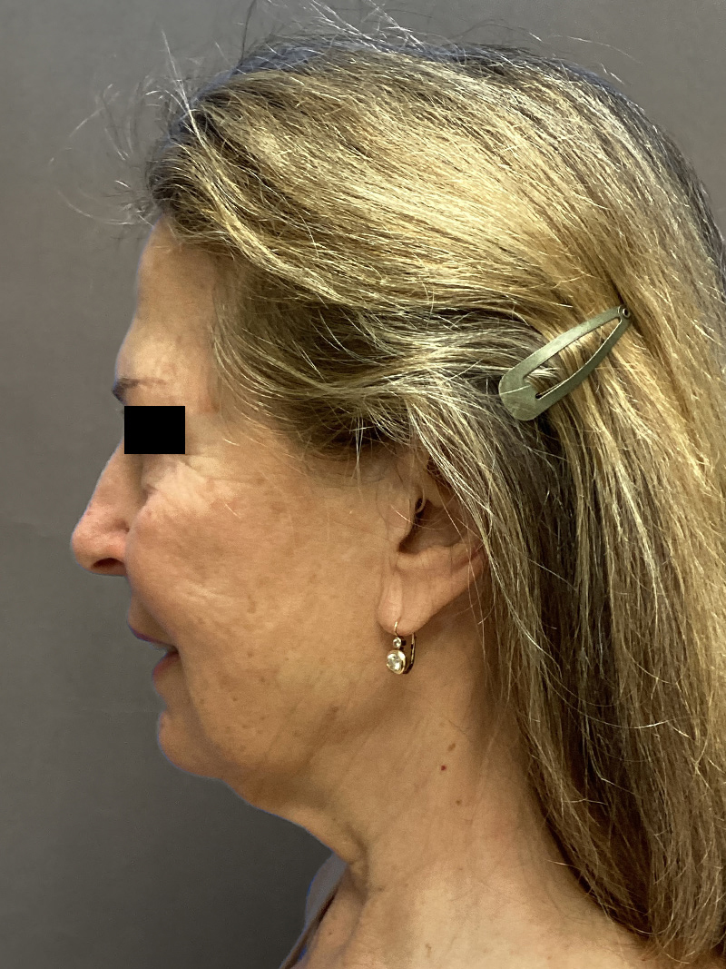 FAT GRAFTING Before & After Gallery - Patient 202145 - Image 7