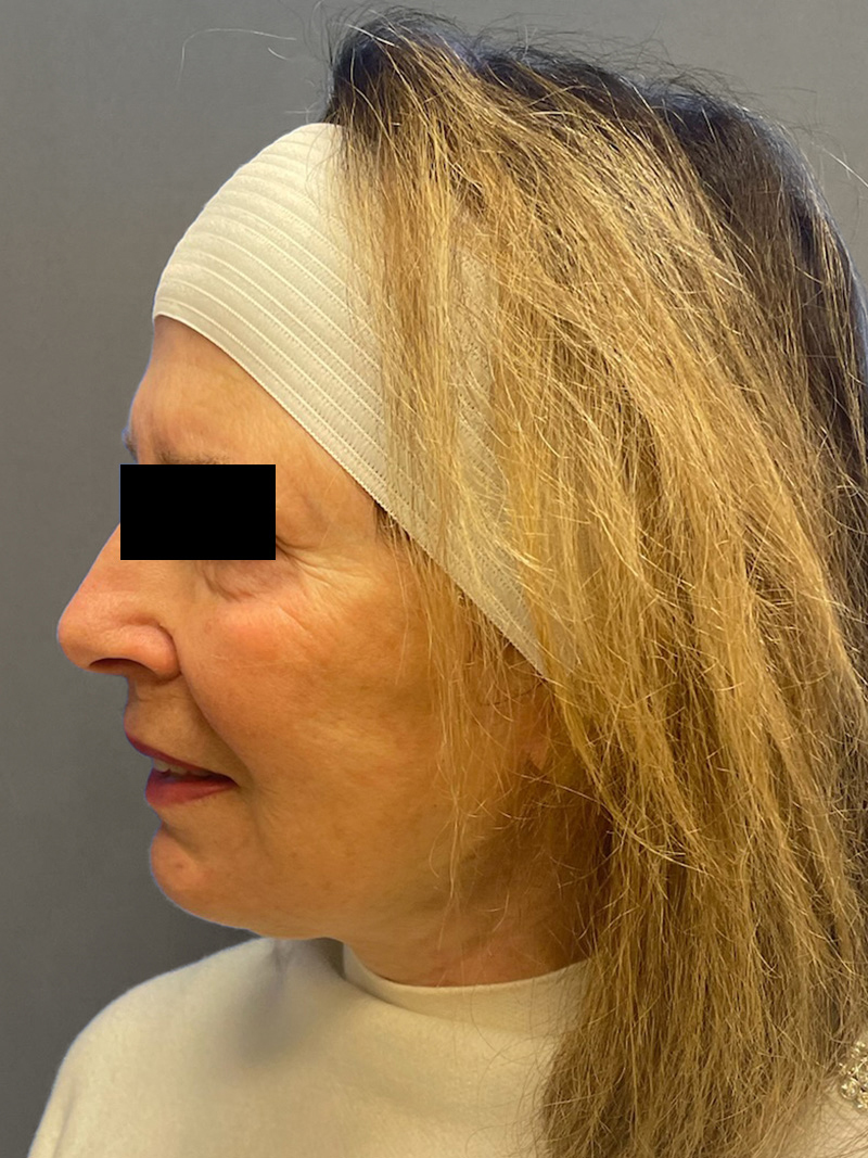 FAT GRAFTING Before & After Gallery - Patient 202145 - Image 8