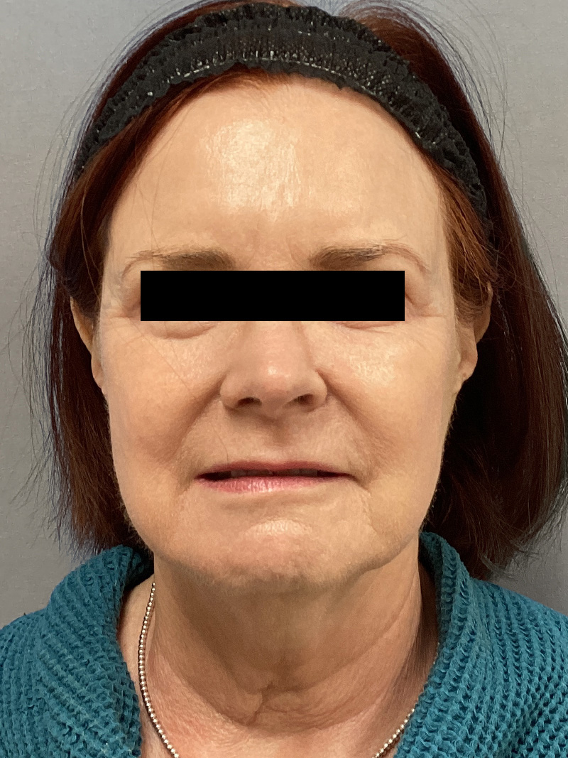 FAT GRAFTING Before & After Gallery - Patient 222619 - Image 1