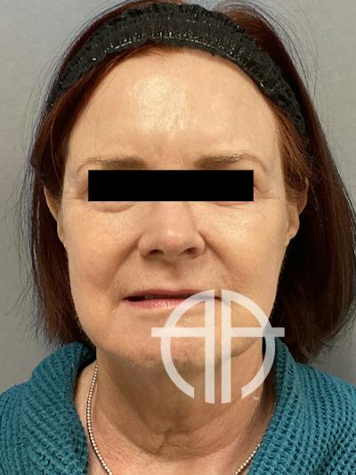 FAT GRAFTING Before & After Gallery - Patient 222619 - Image 1