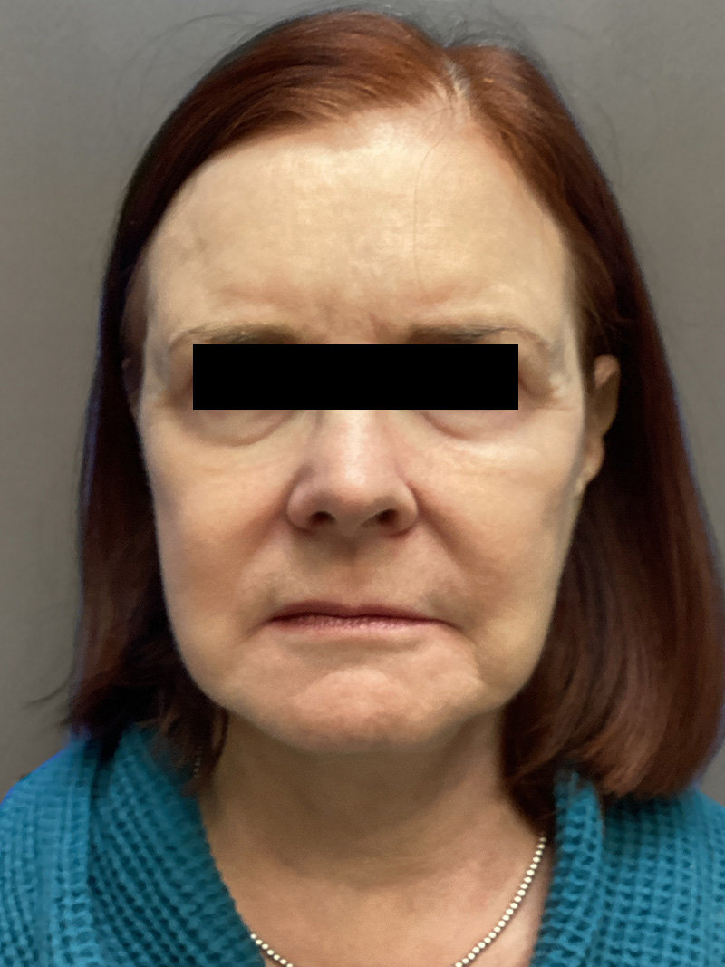 FAT GRAFTING Before & After Gallery - Patient 222619 - Image 2