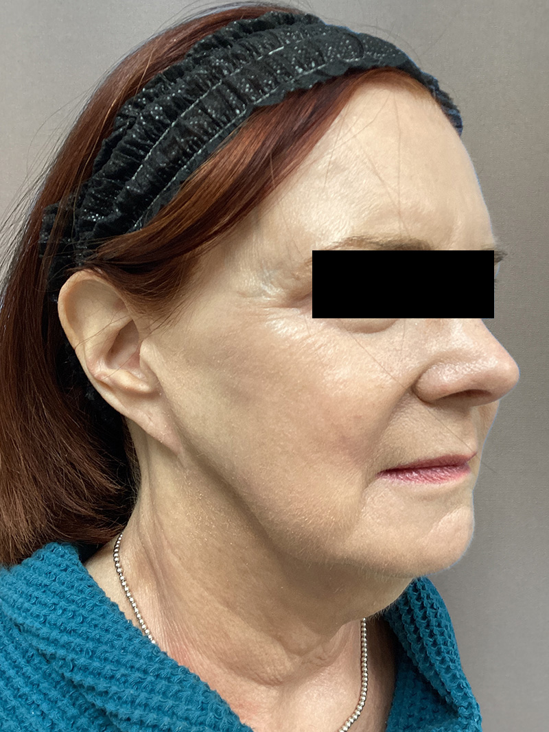 FAT GRAFTING Before & After Gallery - Patient 222619 - Image 3