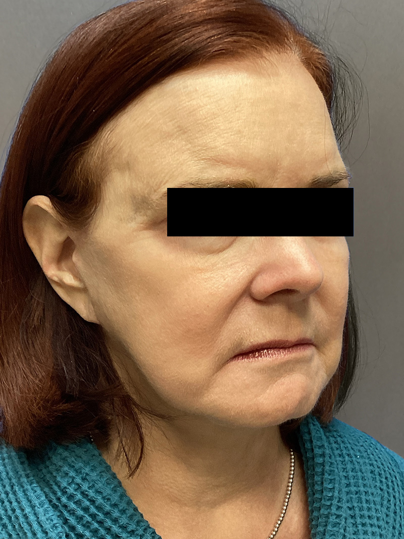 FAT GRAFTING Before & After Gallery - Patient 222619 - Image 4