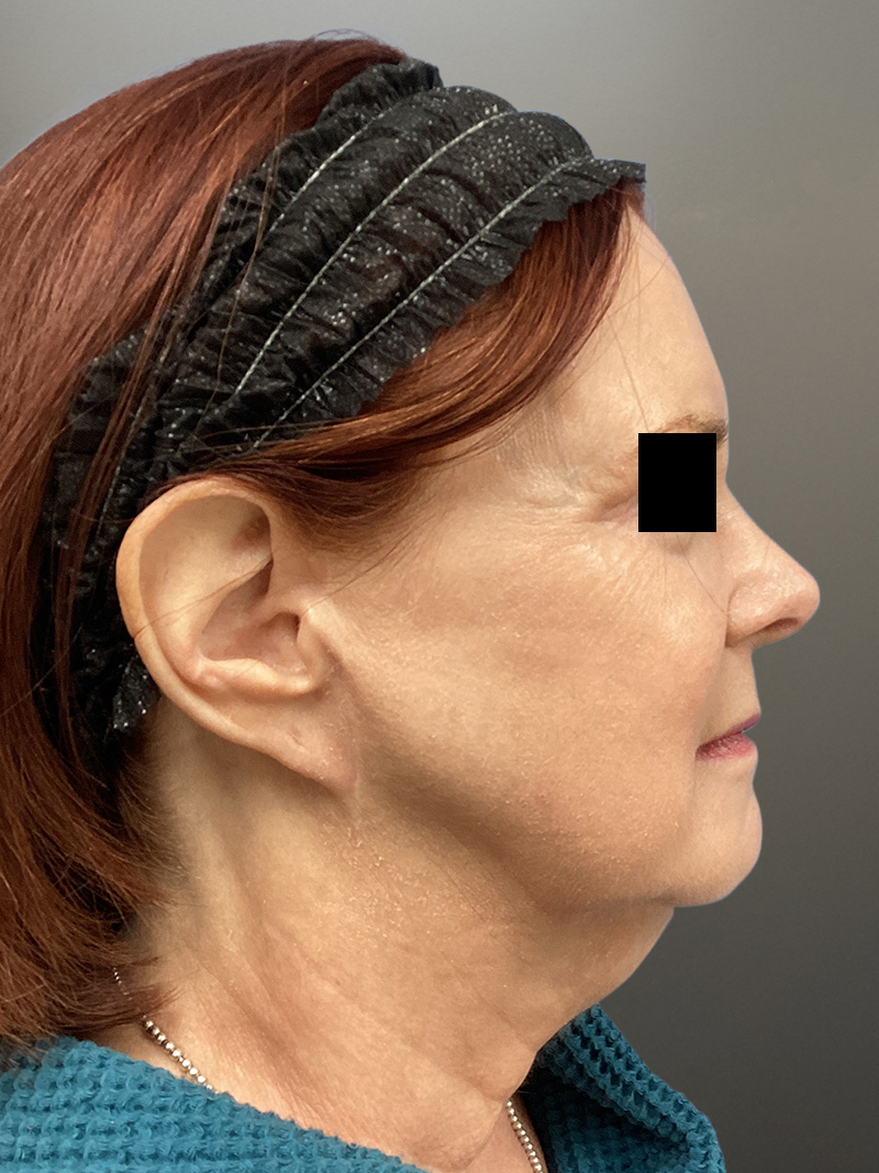 FAT GRAFTING Before & After Gallery - Patient 222619 - Image 5