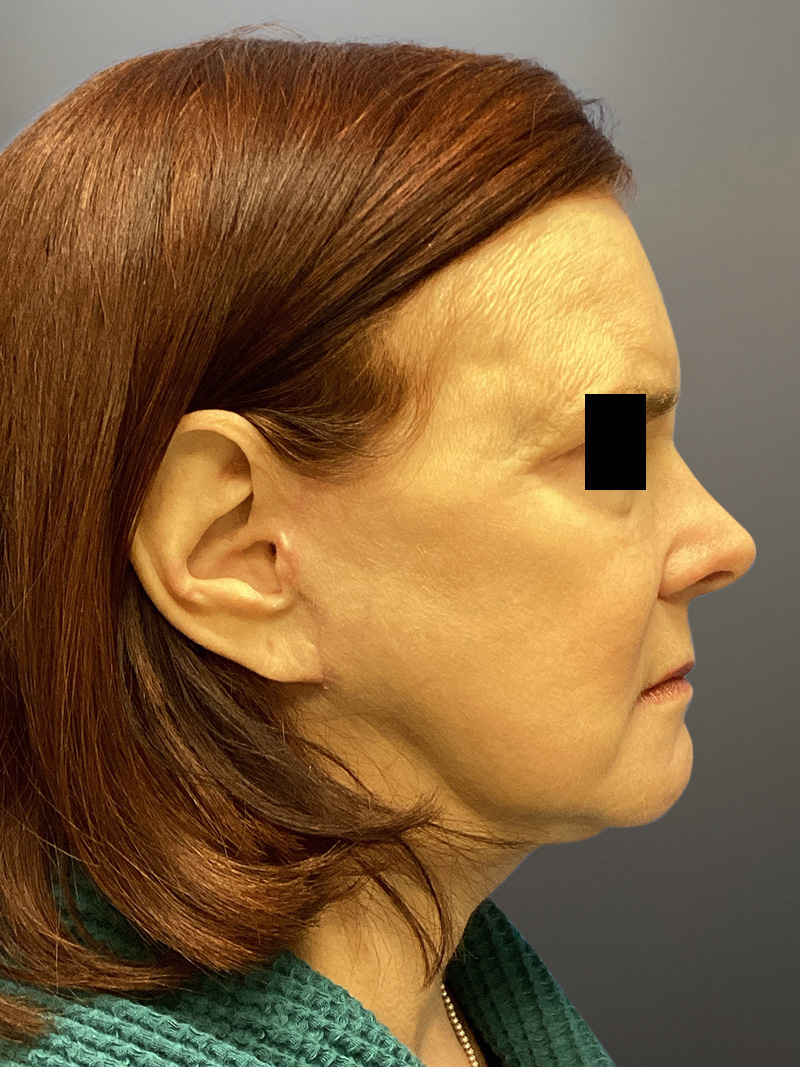 FAT GRAFTING Before & After Gallery - Patient 222619 - Image 6