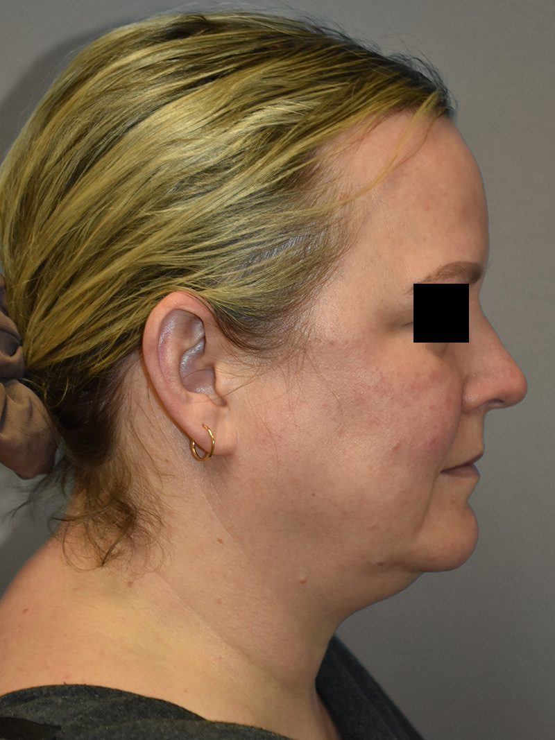 FAT GRAFTING Before & After Gallery - Patient 240927 - Image 7