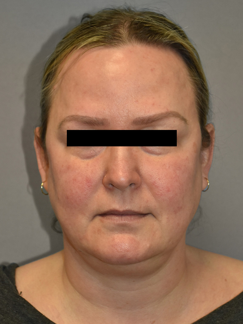 FAT GRAFTING Before & After Gallery - Patient 240927 - Image 3