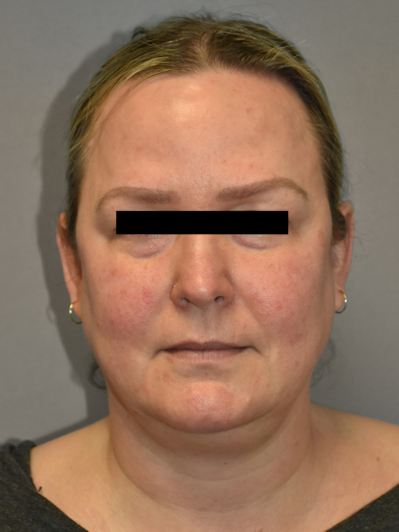 FAT GRAFTING Before & After Gallery - Patient 240927 - Image 1