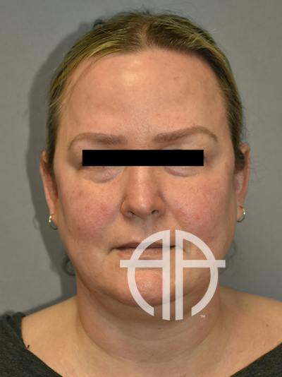 FAT GRAFTING Before & After Gallery - Patient 240927 - Image 1