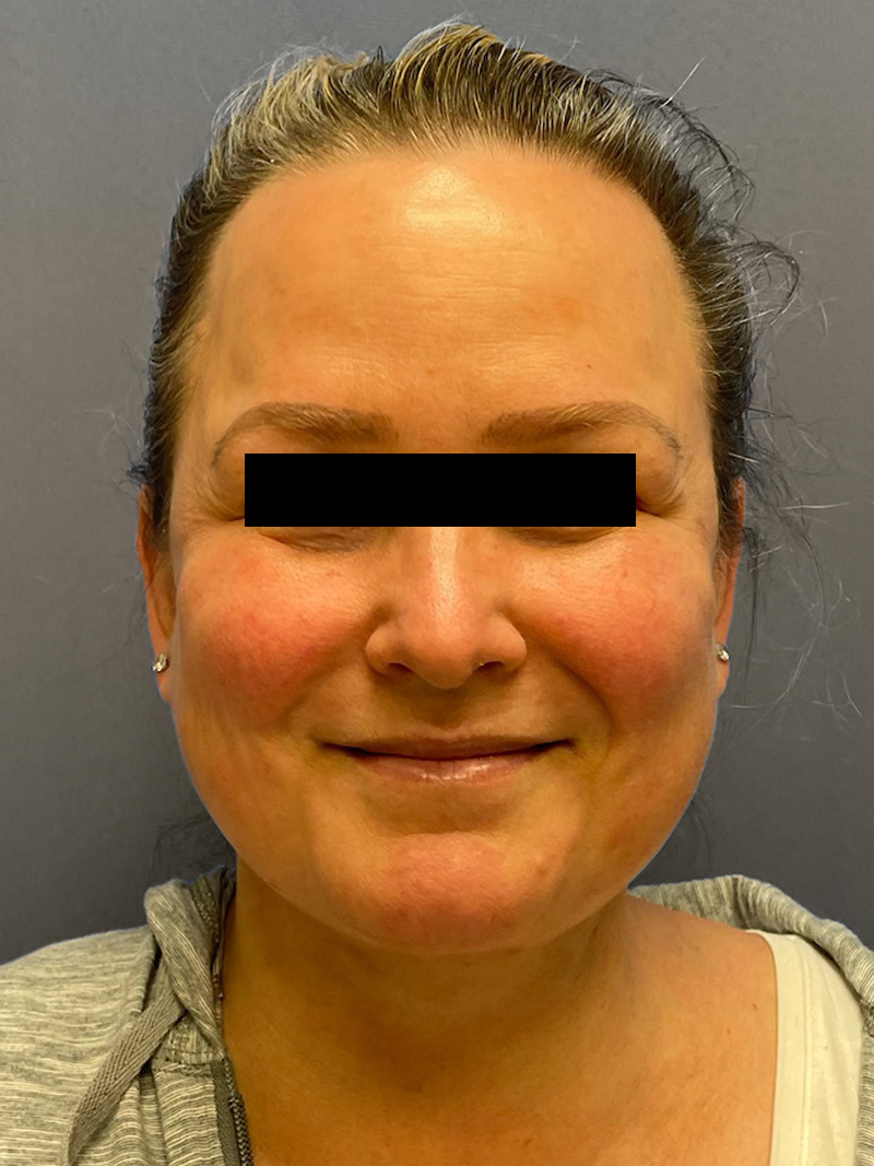 FAT GRAFTING Before & After Gallery - Patient 240927 - Image 4