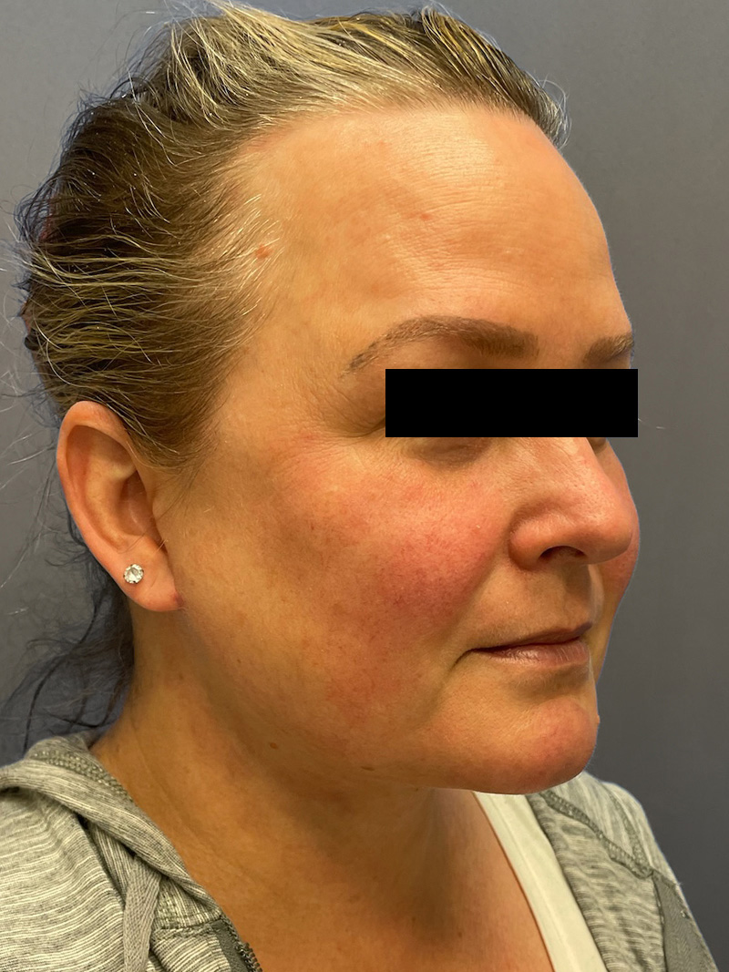 FAT GRAFTING Before & After Gallery - Patient 240927 - Image 6