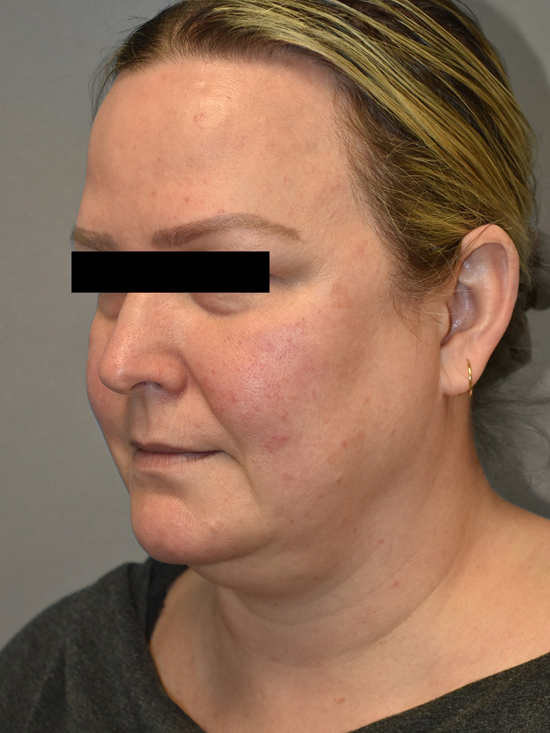 FAT GRAFTING Before & After Gallery - Patient 240927 - Image 9