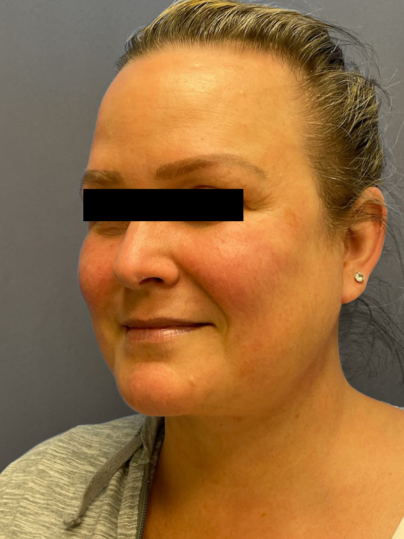 FAT GRAFTING Before & After Gallery - Patient 240927 - Image 10