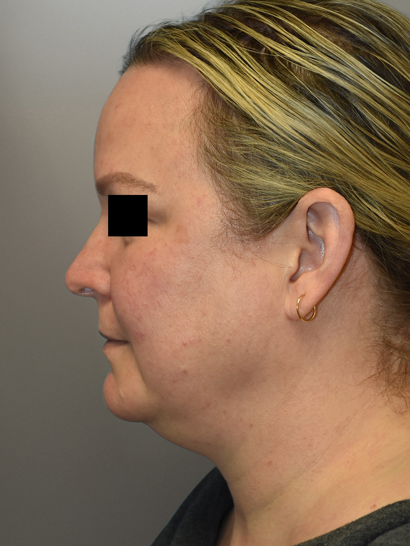 FAT GRAFTING Before & After Gallery - Patient 240927 - Image 11