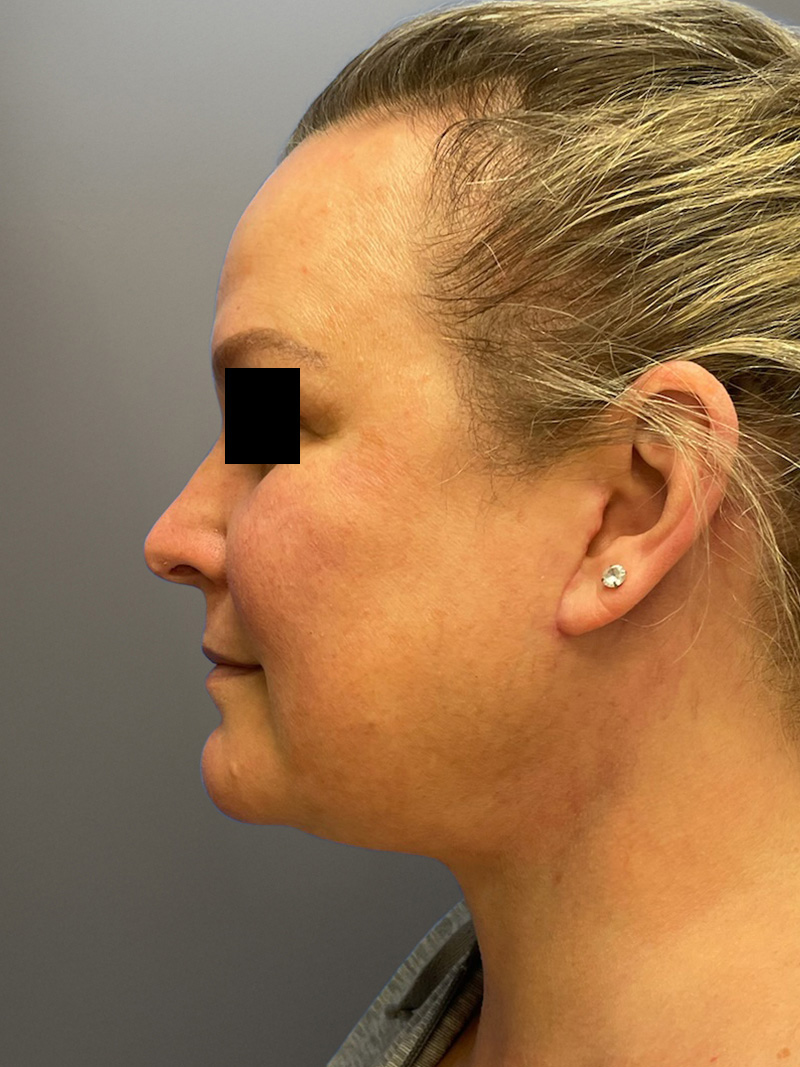 FAT GRAFTING Before & After Gallery - Patient 240927 - Image 12